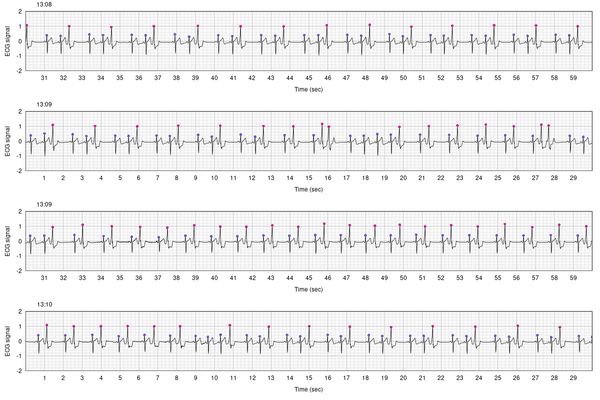 ECG data showing stretches of trigeminy and bigeminy