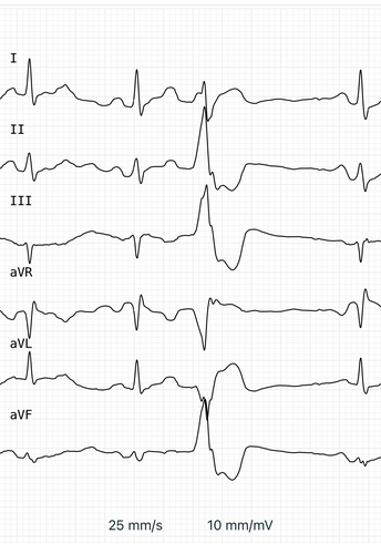 Kardia 6-lead ECG trace showing two normal beats, a PVC, and then anormal beat