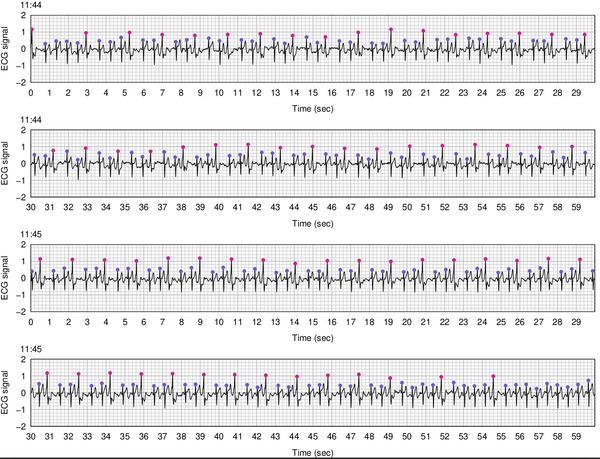 2 min data from a Polar H10 with a peaks identified as either normal (blue) or PVC (pink)